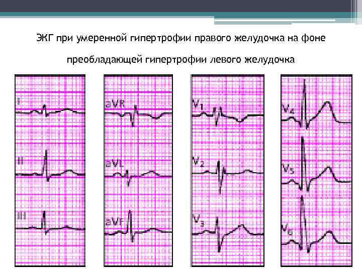 ЭКГ при умеренной гипертрофии правого желудочка на фоне преобладающей гипертрофии левого желудочка 