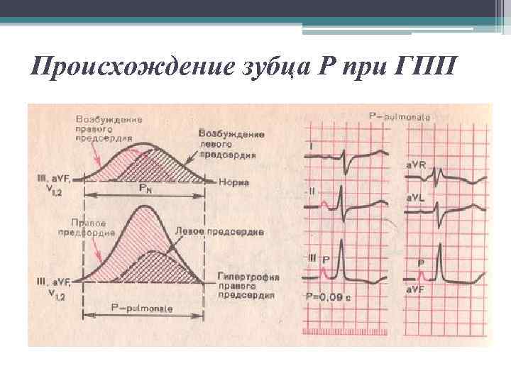 Происхождение зубца Р при ГПП 