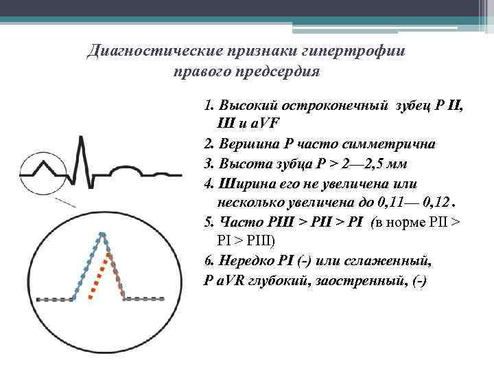 Диагностические признаки гипертрофии правого предсердия 1. Высокий остроконечный зубец Р II, III и a.