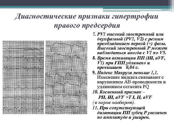 Диагностические признаки гипертрофии правого предсердия 7. РV 1 высокий заостренный или двухфазный (PV 1,