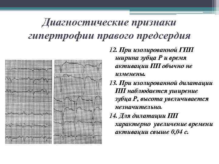 Диагностические признаки гипертрофии правого предсердия 12. При изолированной ГПП ширина зубца Р и время