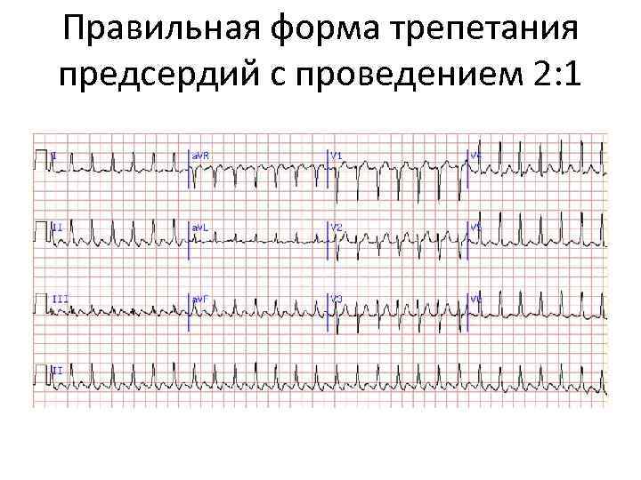 Правильная форма трепетания предсердий с проведением 2: 1 