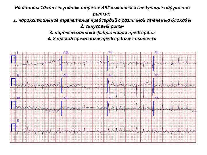 На данном 10 ти секундном отрезке ЭКГ выявляюся следующие нарушения ритма: 1. пароксизмальное трепетание