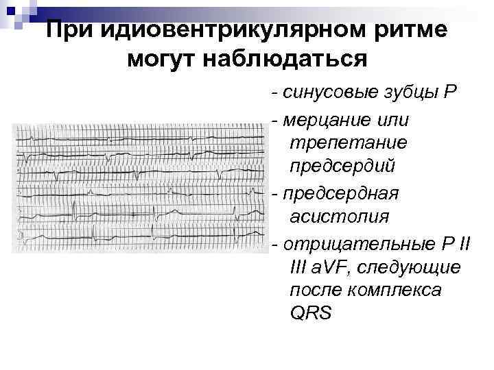 При идиовентрикулярном ритме могут наблюдаться - синусовые зубцы Р - мерцание или трепетание предсердий