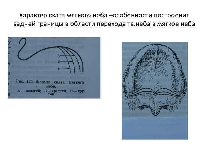 Характер ската мягкого неба –особенности построения задней границы в области перехода тв. неба в