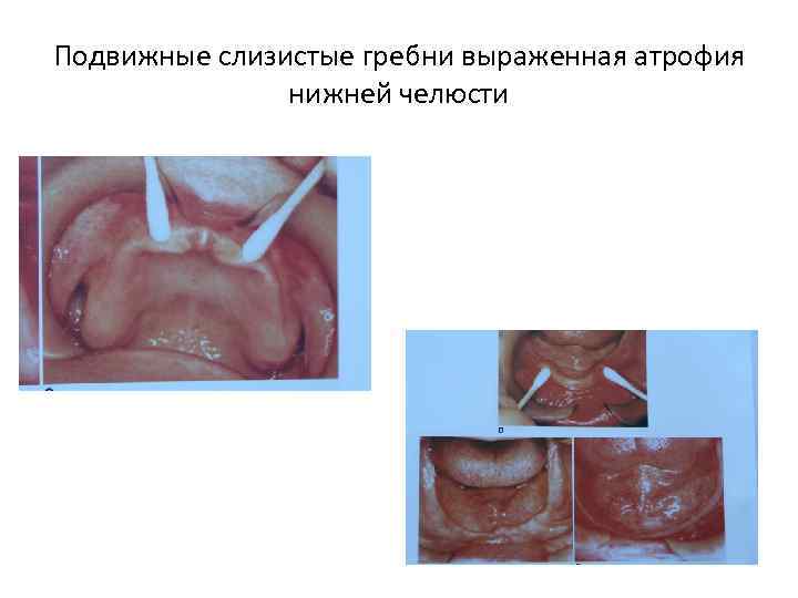 Подвижные слизистые гребни выраженная атрофия нижней челюсти 