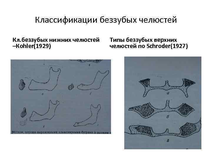 Классификации беззубых челюстей Кл. беззубых нижних челюстей –Кohler(1929) Типы беззубых верхних челюстей по Schroder(1927)