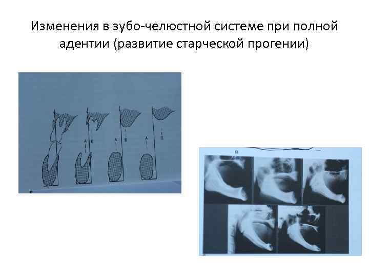 Изменения в зубо-челюстной системе при полной адентии (развитие старческой прогении) 