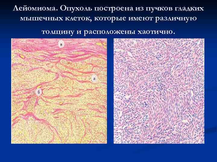 Лейомиома. Опухоль построена из пучков гладких мышечных клеток, которые имеют различную толщину и расположены