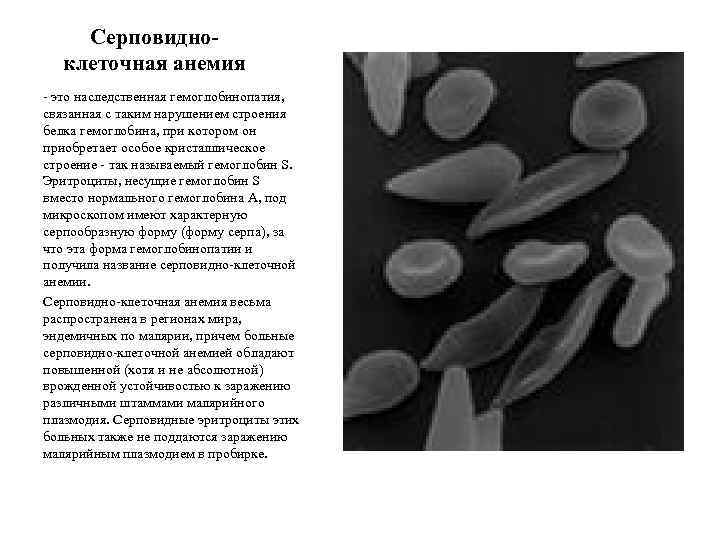 Серповидноклеточная анемия - это наследственная гемоглобинопатия, связанная с таким нарушением строения белка гемоглобина, при