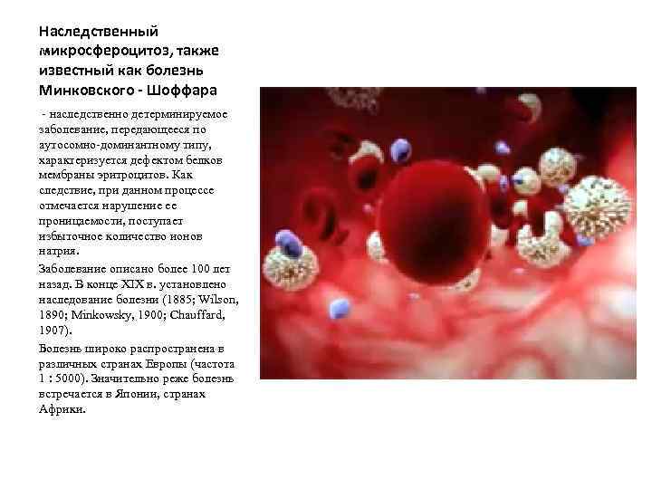 Наследственный микросфероцитоз, также известный как болезнь Минковского - Шоффара - наследственно детерминируемое заболевание, передающееся