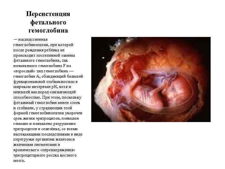 Персистенция фетального гемоглобина — наследственная гемоглобинопатия, при которой после рождения ребёнка не происходит постепенной