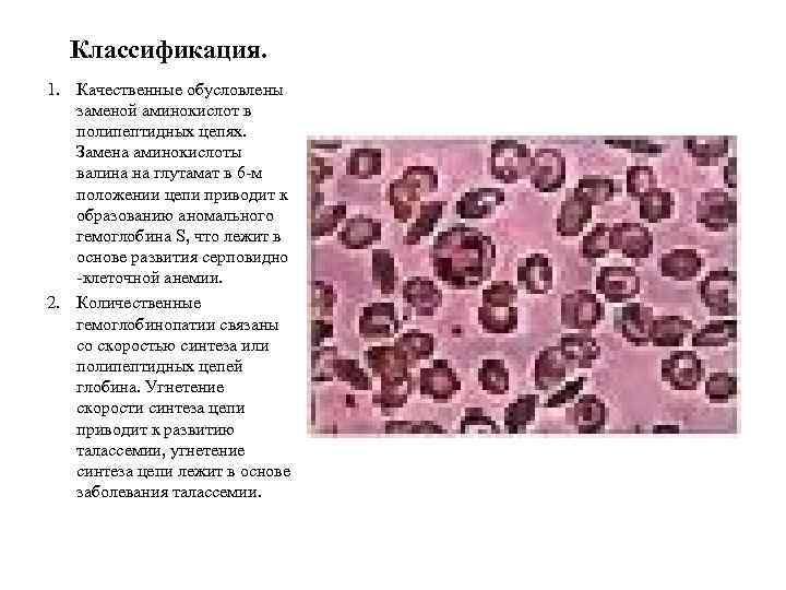 Классификация. 1. Качественные обусловлены заменой аминокислот в полипептидных цепях. Замена аминокислоты валина на глутамат