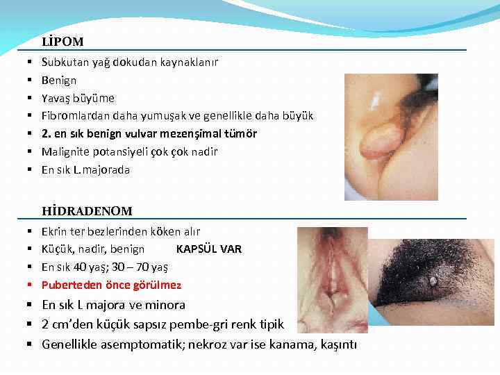 LİPOM § § § § Subkutan yağ dokudan kaynaklanır Benign Yavaş büyüme Fibromlardan daha