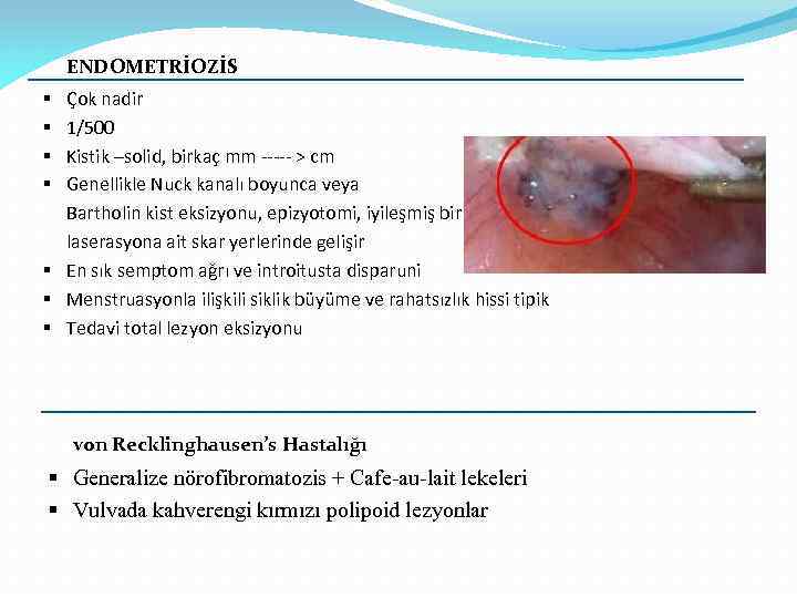 ENDOMETRİOZİS Çok nadir 1/500 Kistik –solid, birkaç mm ----- > cm Genellikle Nuck kanalı