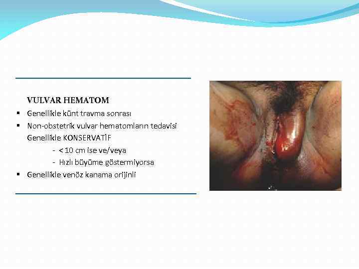 VULVAR HEMATOM § Genellikle künt travma sonrası § Non-obstetrik vulvar hematomların tedavisi Genellikle KONSERVATİF