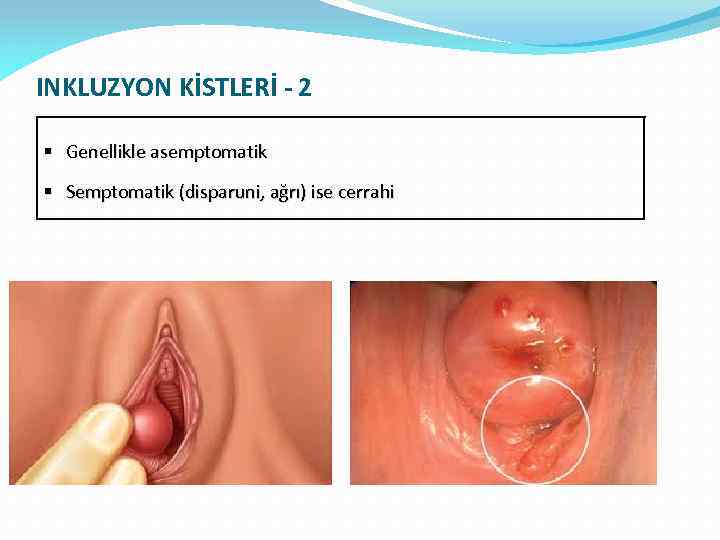 INKLUZYON KİSTLERİ - 2 § Genellikle asemptomatik § Semptomatik (disparuni, ağrı) ise cerrahi 