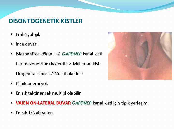 DİSONTOGENETİK KİSTLER § Embriyolojik § İnce duvarlı § Mezonefroz kökenli GARDNER kanal kisti Perimezonefrium