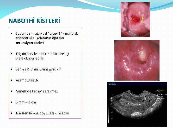 NABOTHİ KİSTLERİ § Squamoz metaplazi ile çevrili kanallarda endoservikal kolumnar epitelin retansiyon kistleri §