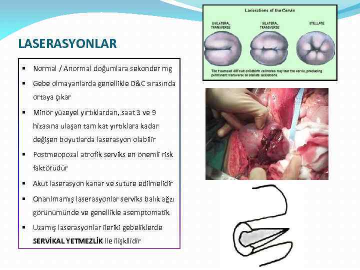 LASERASYONLAR § Normal / Anormal doğumlara sekonder mg § Gebe olmayanlarda genellikle D&C sırasında