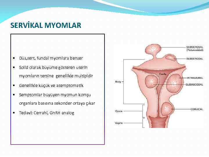 SERVİKAL MYOMLAR § Düz, sert, fundal myomlara benzer § Solid olarak büyüme gösteren uterin