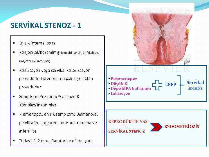 SERVİKAL STENOZ - 1 § En sık internal os ta § Konjenital/Kazanılmış (cerrahi, atrofi,