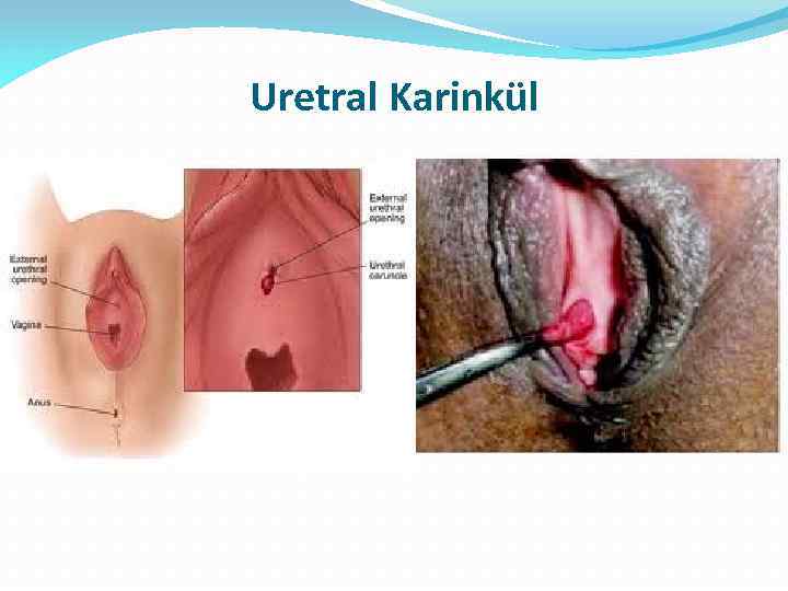 Uretral Karinkül 
