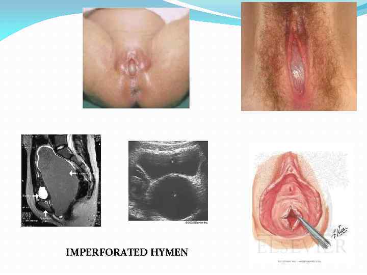 IMPERFORATED HYMEN 