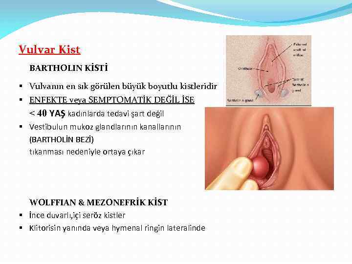 Vulvar Kist BARTHOLIN KİSTİ § Vulvanın en sık görülen büyük boyutlu kistleridir § ENFEKTE