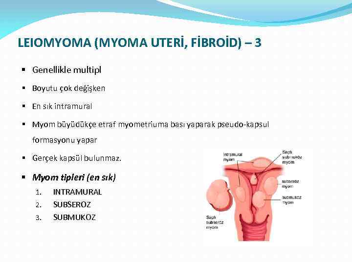LEIOMYOMA (MYOMA UTERİ, FİBROİD) – 3 § Genellikle multipl § Boyutu çok değişken §