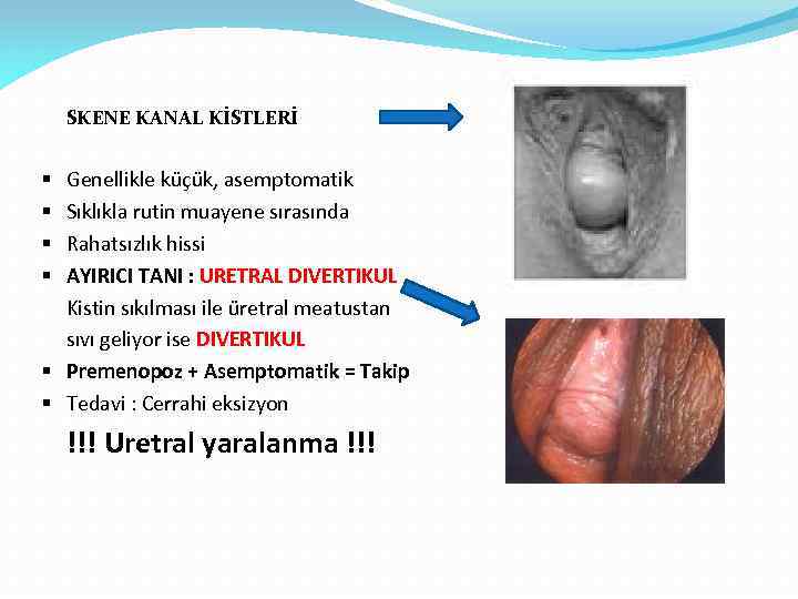 SKENE KANAL KİSTLERİ Genellikle küçük, asemptomatik Sıklıkla rutin muayene sırasında Rahatsızlık hissi AYIRICI TANI