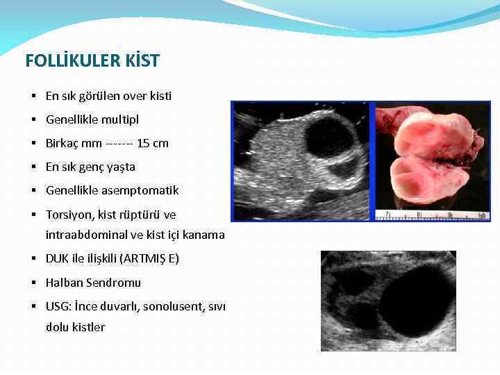 FOLLİKULER KİST § En sık görülen over kisti § Genellikle multipl § Birkaç mm