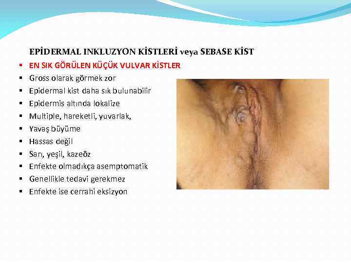 EPİDERMAL INKLUZYON KİSTLERİ veya SEBASE KİST § § § EN SIK GÖRÜLEN KÜÇÜK VULVAR