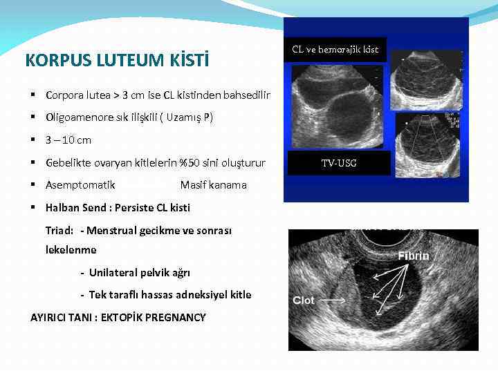 KORPUS LUTEUM KİSTİ CL ve hemorajik kist § Corpora lutea > 3 cm ise