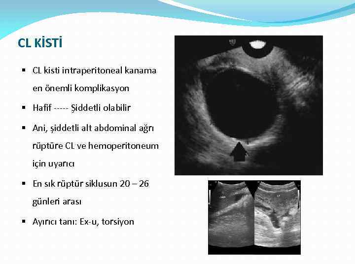 CL KİSTİ § CL kisti intraperitoneal kanama en önemli komplikasyon § Hafif ----- Şiddetli