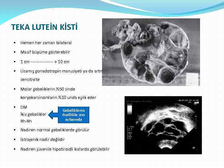 TEKA LUTEİN KİSTİ § Hemen her zaman bilateral § Masif büyüme gösterebilir § 1