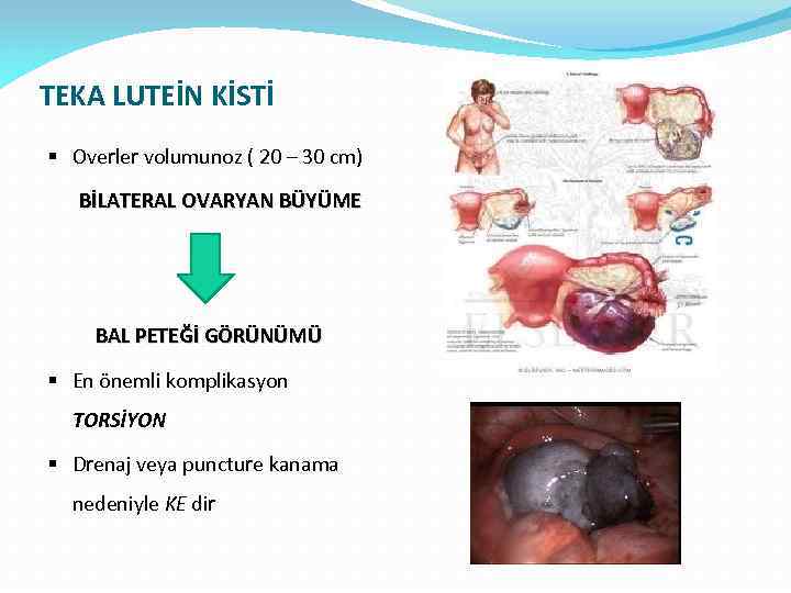 TEKA LUTEİN KİSTİ § Overler volumunoz ( 20 – 30 cm) BİLATERAL OVARYAN BÜYÜME