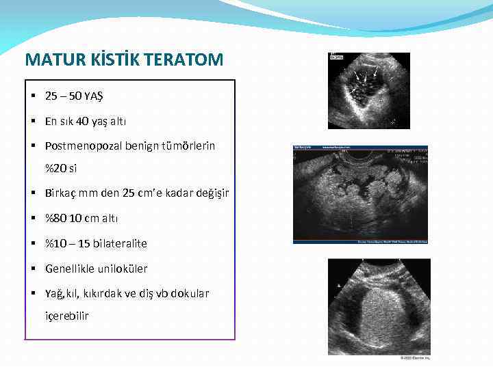 MATUR KİSTİK TERATOM § 25 – 50 YAŞ § En sık 40 yaş altı