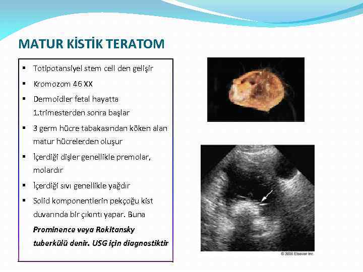 MATUR KİSTİK TERATOM § Totipotansiyel stem cell den gelişir § Kromozom 46 XX §