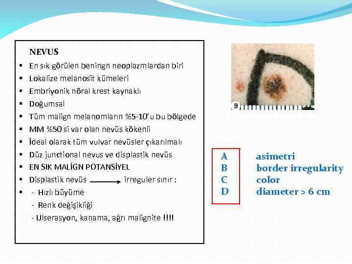 NEVUS § § § En sık görülen beningn neoplazmlardan biri Lokalize melanosit kümeleri Embriyonik