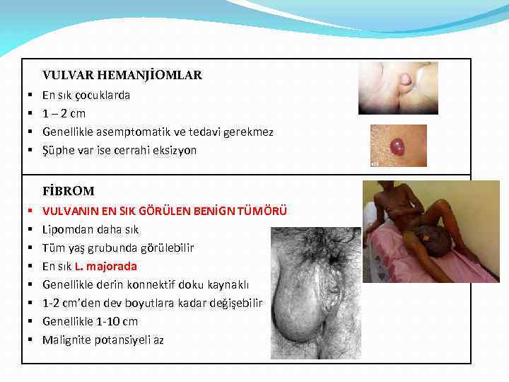 VULVAR HEMANJİOMLAR § § En sık çocuklarda 1 – 2 cm Genellikle asemptomatik ve