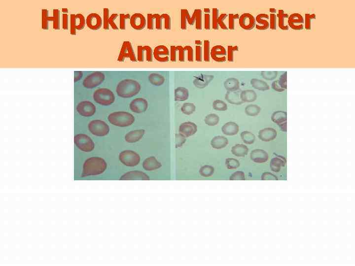 Hipokrom Mikrositer Anemiler 