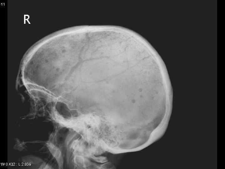  What is the cause for renal failure in MM? 