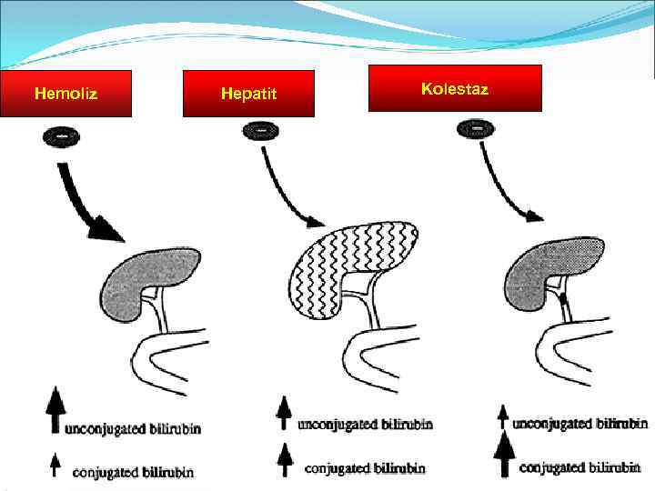 Hemoliz Hepatit Kolestaz 