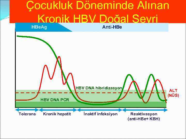 Çocukluk Döneminde Alınan Kronik HBV Doğal Seyri HBe. Ag Anti-HBe HBV DNA hibridizasyon ALT