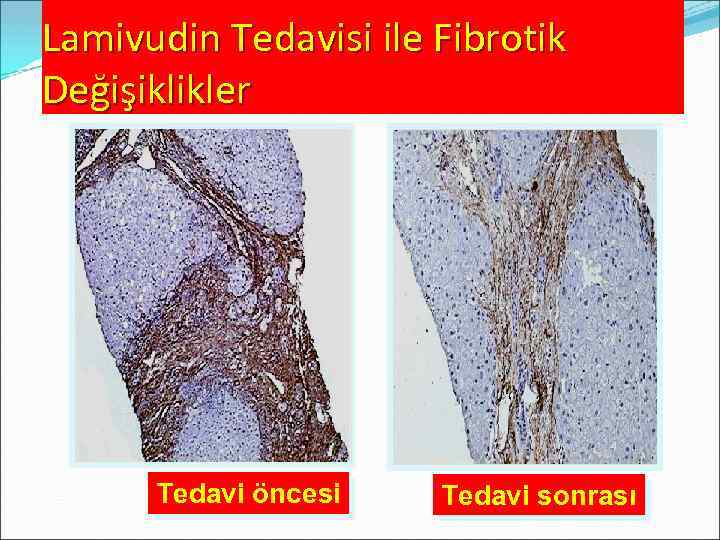 Lamivudin Tedavisi ile Fibrotik Değişiklikler Tedavi öncesi Post-LAM Tedavi sonrası 