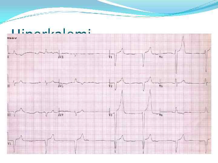 Hiperkalemi 