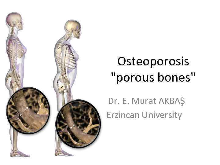 Osteoporosis "porous bones" Dr. E. Murat AKBAŞ Erzincan University 