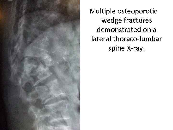 Multiple osteoporotic wedge fractures demonstrated on a lateral thoraco-lumbar spine X-ray. 