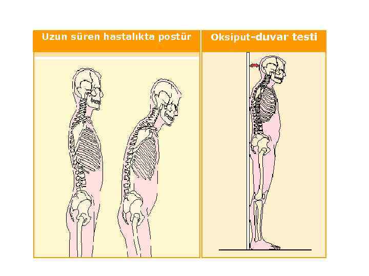 Uzun süren hastalıkta postür Oksiput-duvar testi 